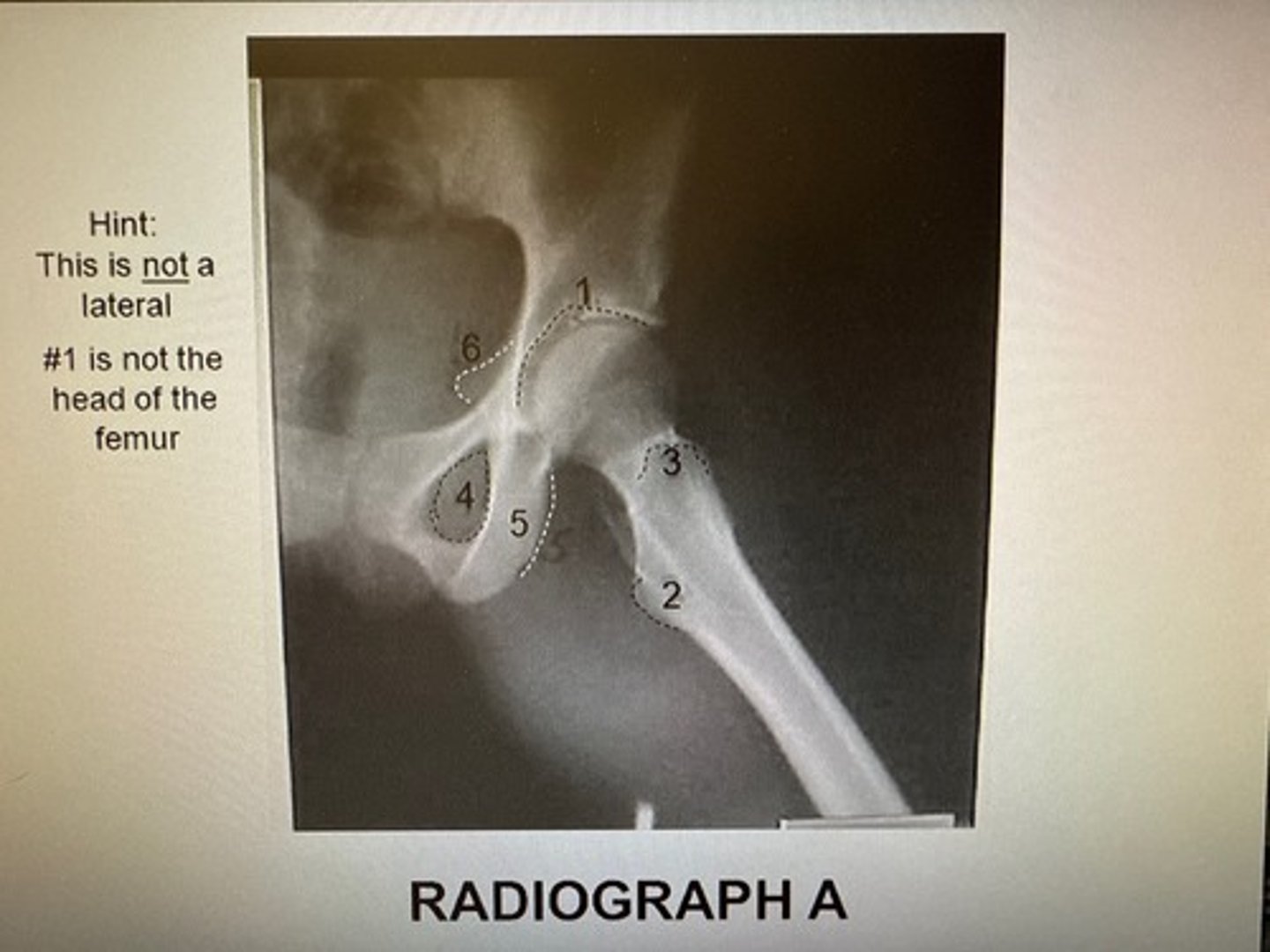 <p>The anatomy marked with #3 is the:</p><p>Acetabulum</p><p>Lesser trochanter</p><p>Obturator foramen</p><p>Greater trochanter</p><p>Ischial spine</p>