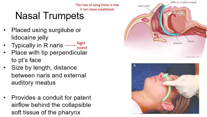   

•Provides a conduit for patent  airflow behind the collapsible  soft tissue of the pharynx

  