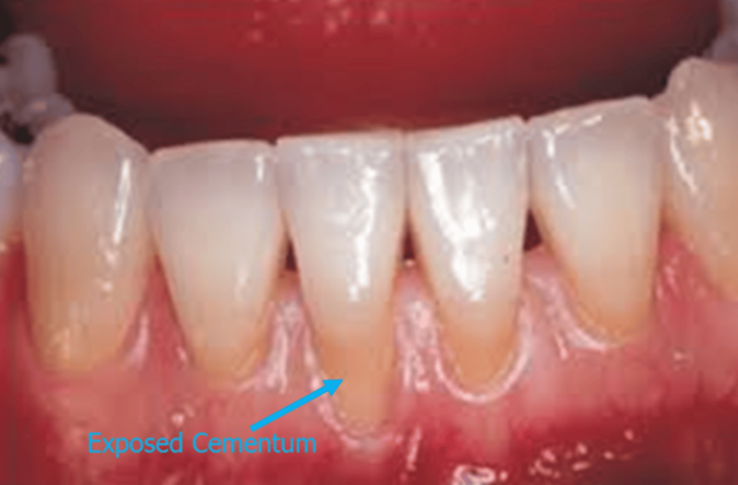 <p>Thin yellow layer of hard mineralized tissue that covers the surface of the root and overlies dentin.</p><p>- it is 55% organic, 45% inorganic material</p><p>- It is softer than dentin and enamel.</p>