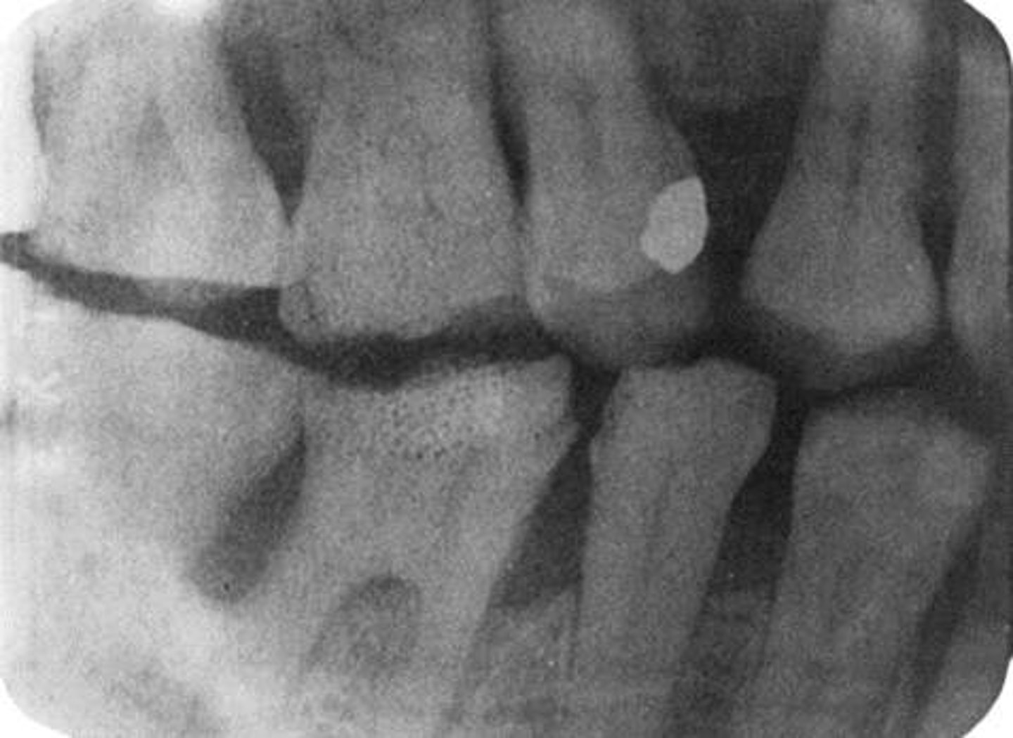 <p>Aged Film Fog = Film emulsion has a shelf life with an expiration date</p><p>Digital Radiographic Noise = Exposure setting too low</p><p>Re-exposing to scattered radiation = Too near the distance from the source of the x-ray after the initial exposure</p>