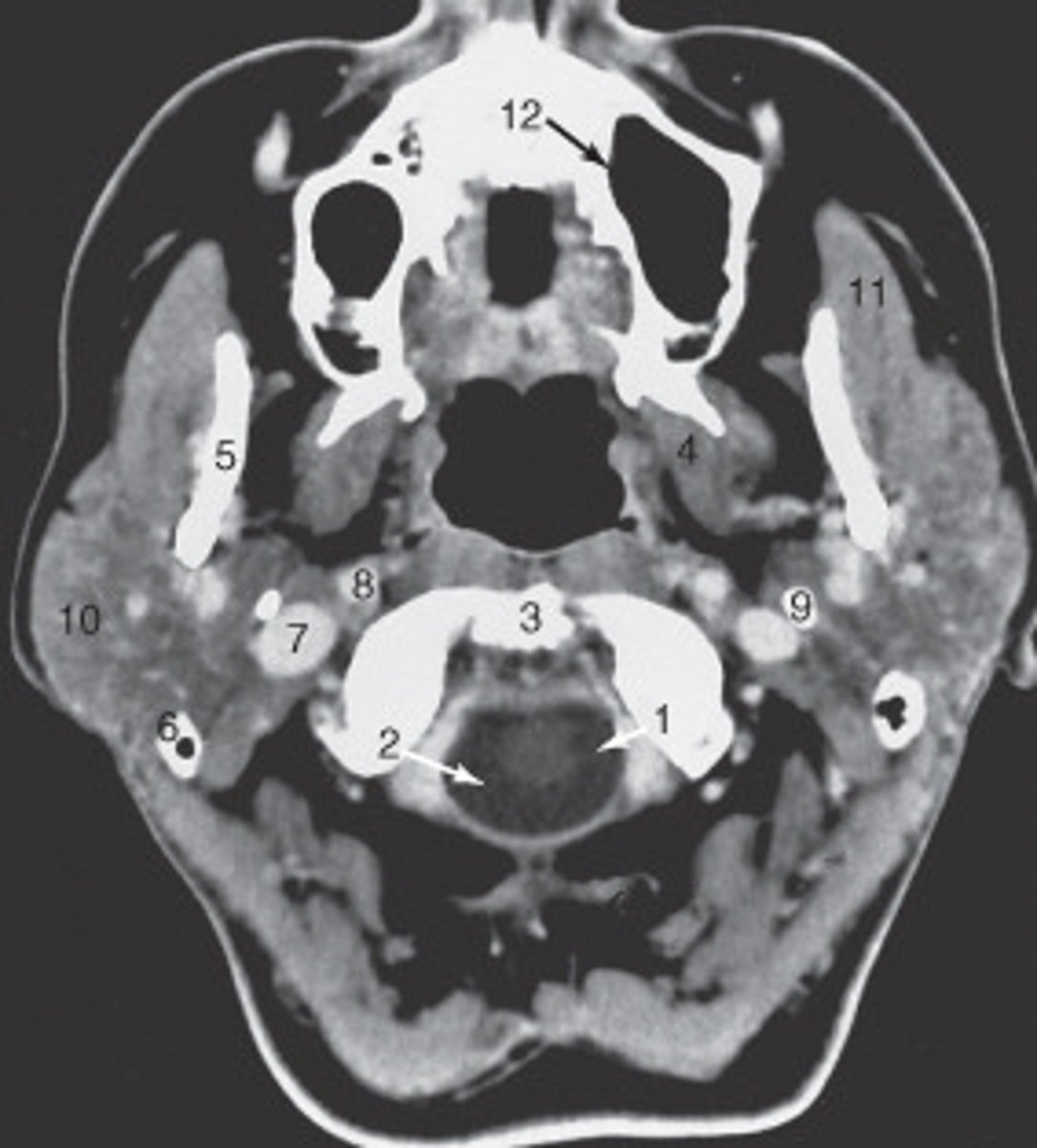 <p>The internal jugular vein is labeled:</p>