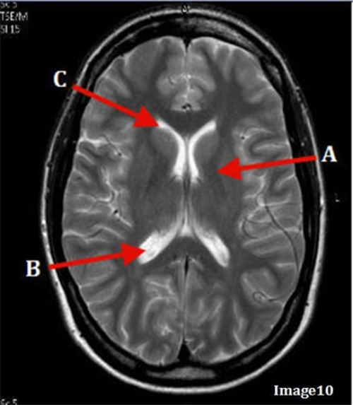 <p>Letter A in Image 10 is pointing to: </p><p>A. Third Ventricle</p><p>B. Basal ganglia</p><p>C. Anterior horn Lateral Ventricle</p><p>D. Posterior horn lateral ventricle</p>