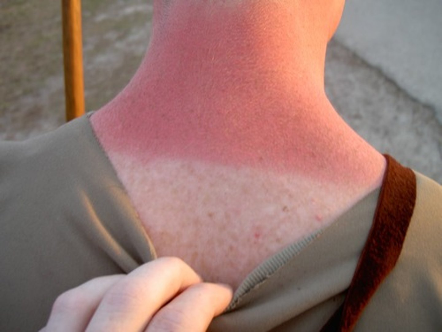 <p>a sunburn</p>