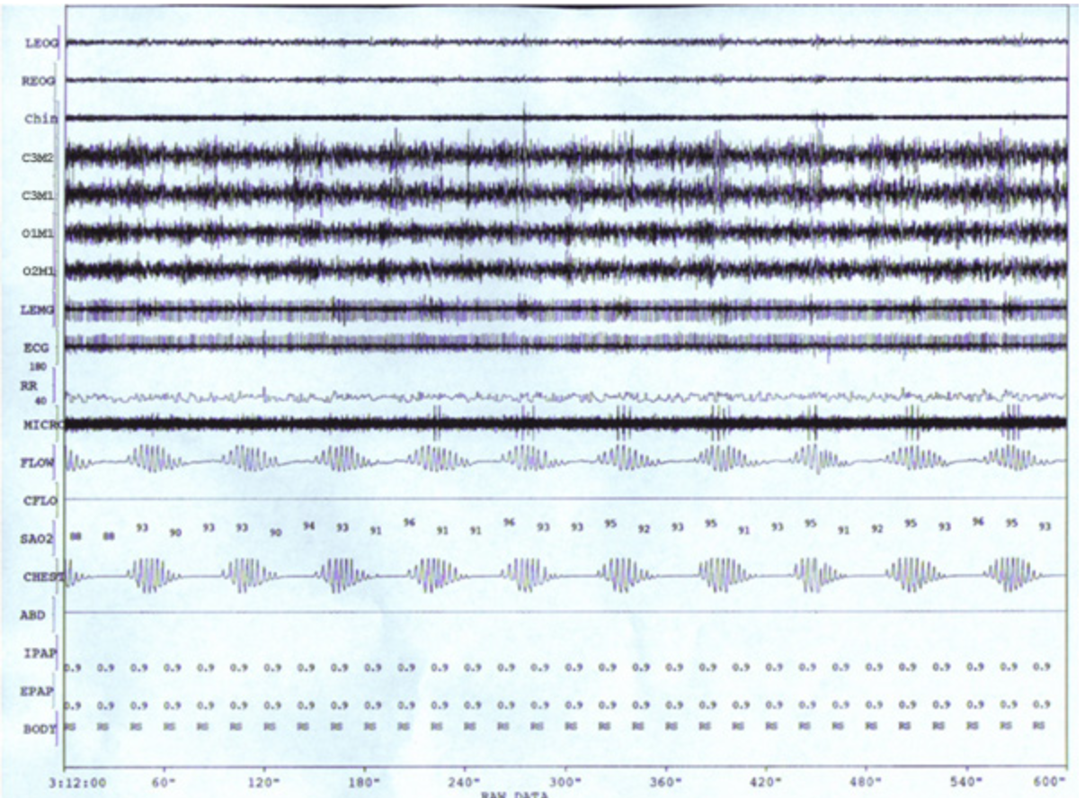 <p>A sleep disorder specialist evaluates the following 10-minute compressed view of a PSG performed on an adult patient. Which of the following should the specialist conclude about the respiratory pattern? </p>