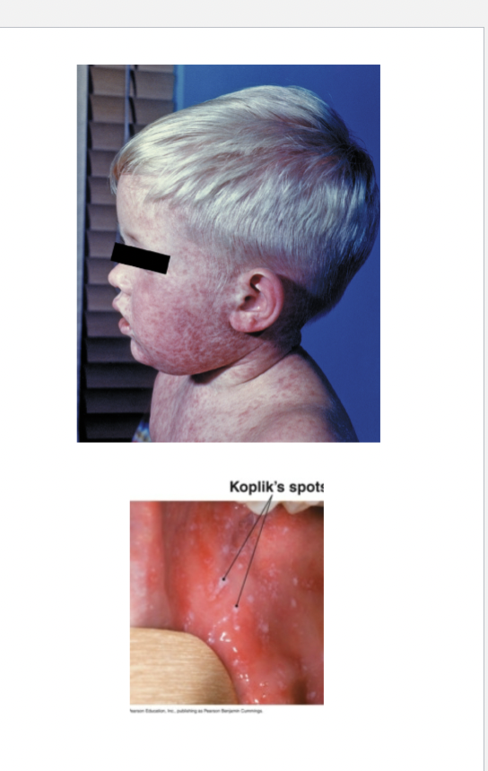 <p>Measles Symptoms</p>