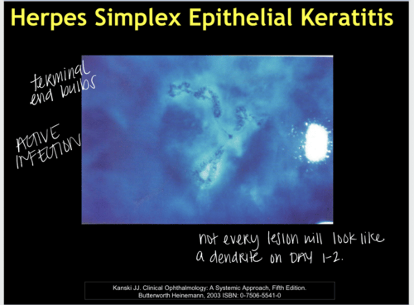 <p>Herpes Simplex Epithelial Keratitis -- Terminal End Bulbs (Pic)</p>