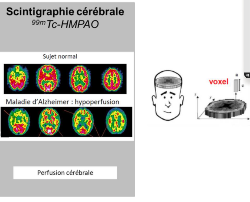 <ul><li><p>On peut faire <strong>des scintigraphies cérébrales</strong> avec le technétium 99 métastable. On étudie la perfusion du cerveau dans l’épilepsie ou les maladies neurodégénératives par exemple.</p><p>Dans la maladie d’alzheimer, on a certaines aires primaires qui sont hypoperfusées</p></li></ul><p></p>