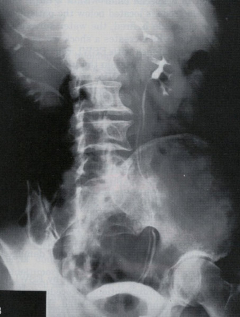 <p>What congenital anomaly occurs when the kidney has two renal pelvises and two ureters?</p>