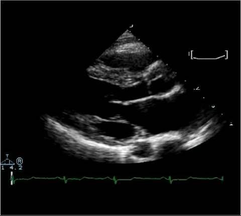 <p>What specific walls of the LV can be assessed for contractility in PSLA?</p>