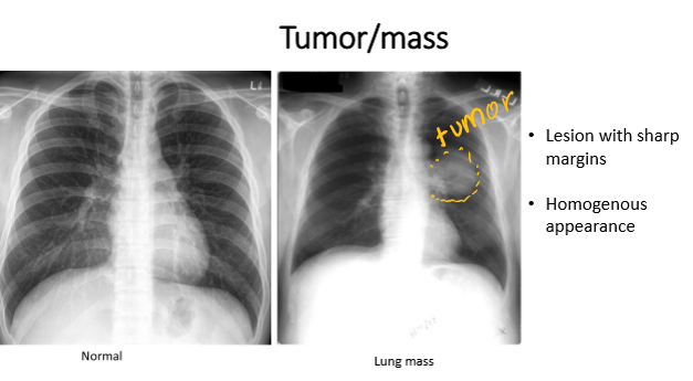 <p>tumor </p>