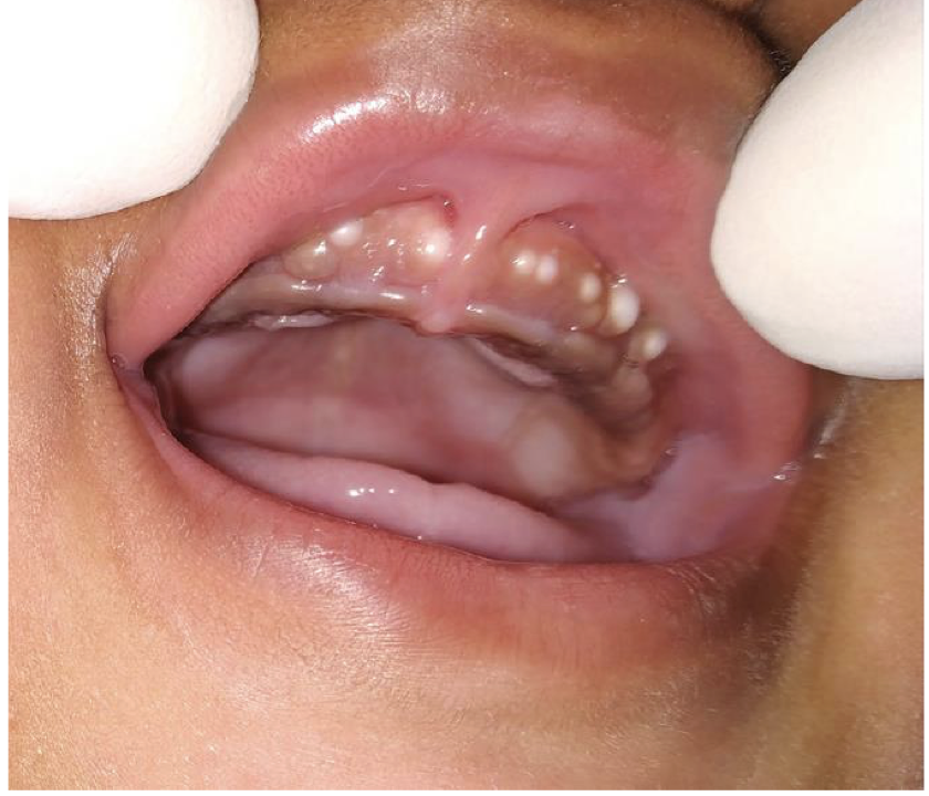 <p>The mother of a 1 month old baby has a concern of white nodules in the mouth of her kid. The clinical image is shown below. There is no pain or any other symptoms. Provide diagnosis and management</p>