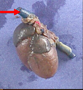 <p>drains deoxygenated blood from the upper body into the right atrium</p>