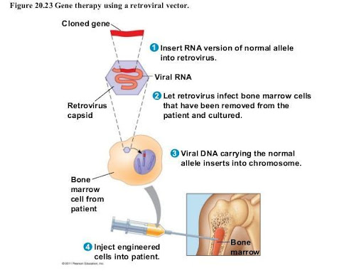 <p>Step 1: A virus is engineered with the gene of interest. The virus is also modified to not cause harm to host cell.</p><p>Step 2: The virus is inserted into host cell for replication. Cells will replicate the gene of interest</p><p>Step 3: The cells are injected into the bone marrow where they will continue to produce more cells with the corrected gene</p>