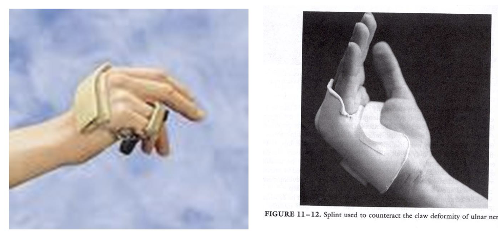 <p>Focus on 4th and 5th digit flexion for increased function</p>