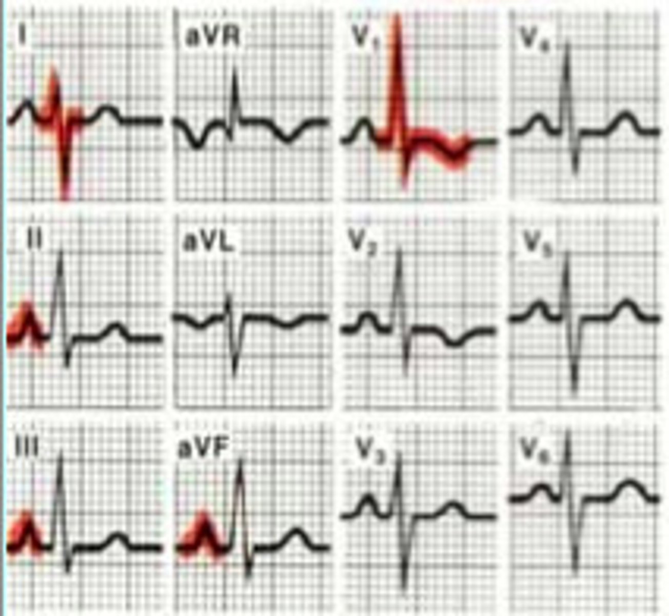 <p>- tall R wave in V1 (inverted T here too)</p><p>- R gets progressively smaller as we go from V1-V4</p><p>- normally V1 has long S wave so looks like big V, when that is not the case think RVH</p><p>causes: Pulm HTN</p><p>(not too common)</p>