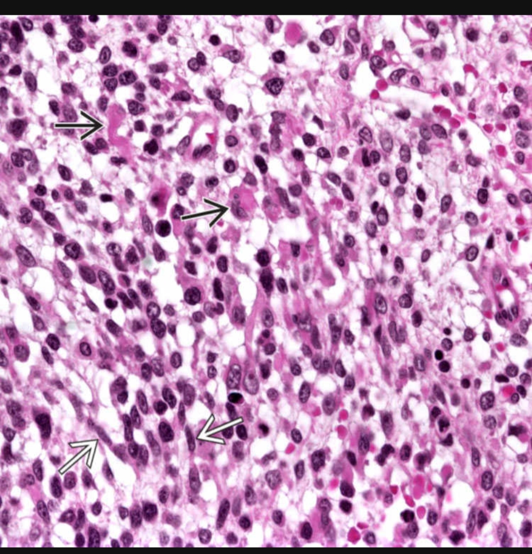 <p>1) alveolar rhabdomyosarcoma</p><p>2)</p><ul><li><p>Fibrovascular cores</p></li><li><p>Nests of small blue round tumor cells looking dyscohesive at the edge because they are fragmented</p></li><li><p>Strap cells (elongated eosinophilic like immature muscle cells) sometimes seen</p></li><li><p>Multinucleated wreath cells (peripheral multimuclei, muscle differentiarion)</p></li><li><p>Rhabdomyoblasta</p></li></ul><p>3)</p><ul><li><p>SBRCT</p></li><li><p>Embryonal rms (less aggressive)</p></li></ul><p>4) children and young adults</p><p>5)</p><ul><li><p>Desmin+</p></li><li><p>MyoD + Myogenin+</p></li></ul><p>6) t(1;13) or t(2;13) = PAX3-FOXO1 or PAX7-FOXO1</p>