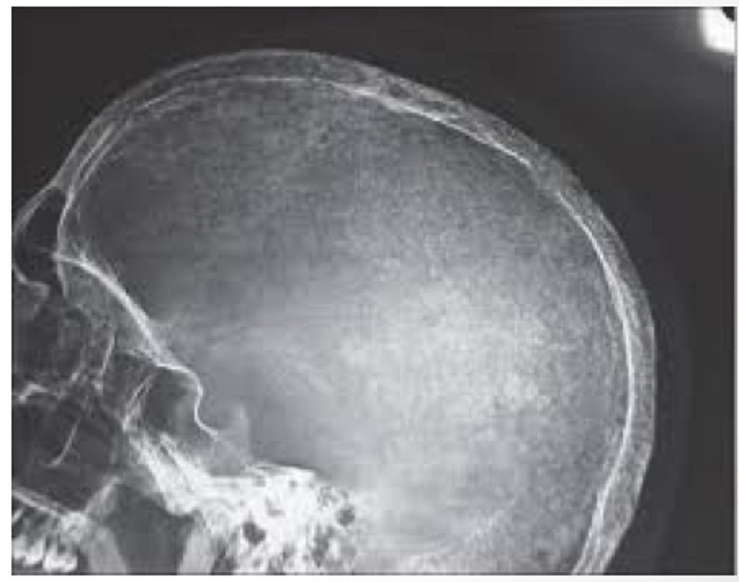 <p>imaging findings associated with Osteitis fibrosa cystica</p>