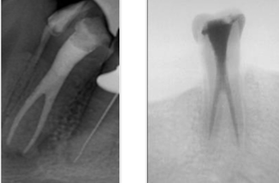 <p>Bi or trifurcations of roots or canals&nbsp;</p>