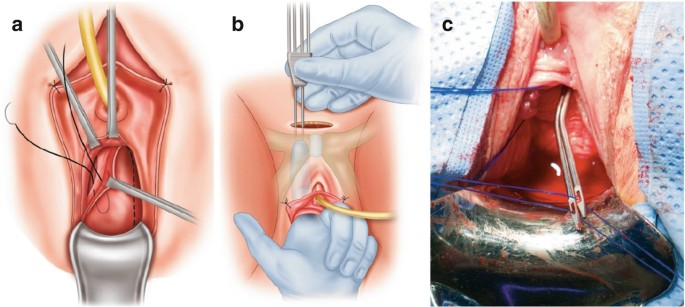 <p>C. bladder suspension</p>