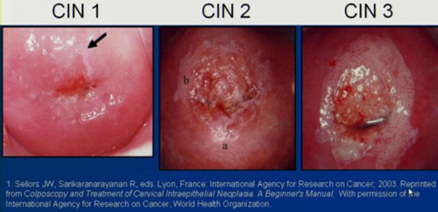 <p>1) Mild cervical dysplasia</p><p>2) Moderate cervical dysplasia</p><p>3) Severe dysplasia and carcinoma in situ </p>