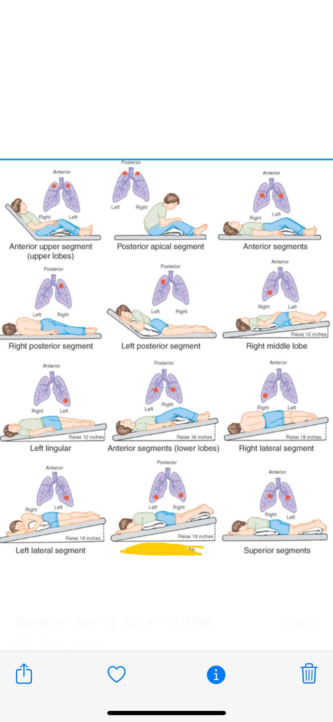 <p><span>Which lung segment does this position effect</span></p>