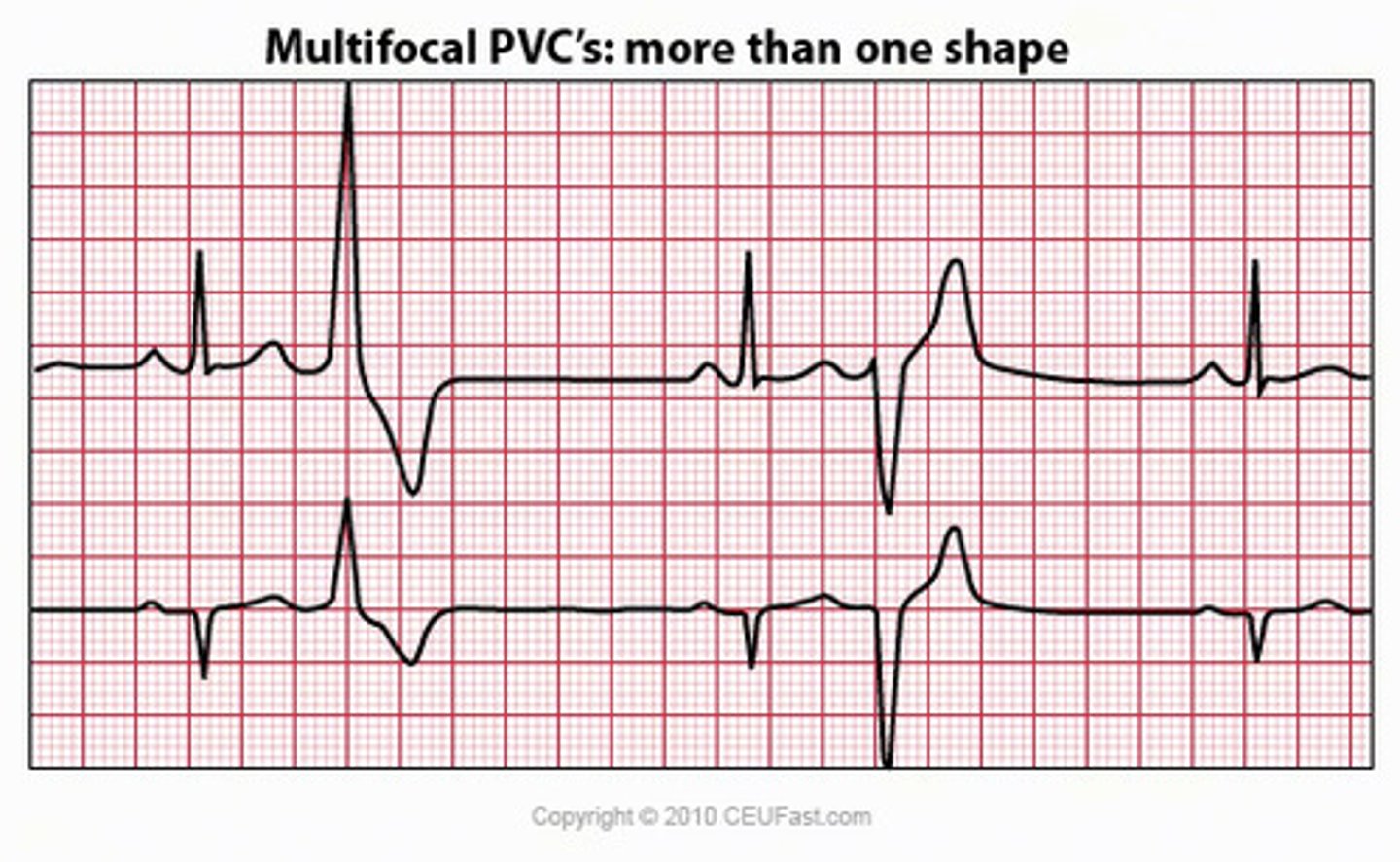 <p>PVCs that differ in size, shape, and direction</p>