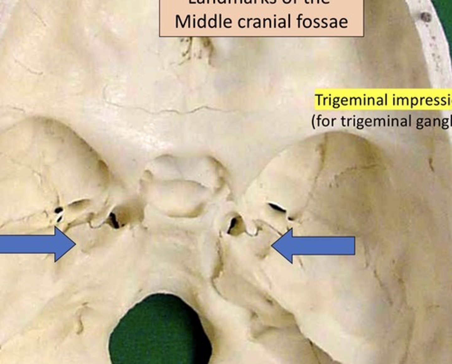 <p>1. For Trigeminal ganglion</p><p>2. Where sensation nerve sits</p><p>3. Medial center of skull</p><p>4. Sits on petrous bone</p>