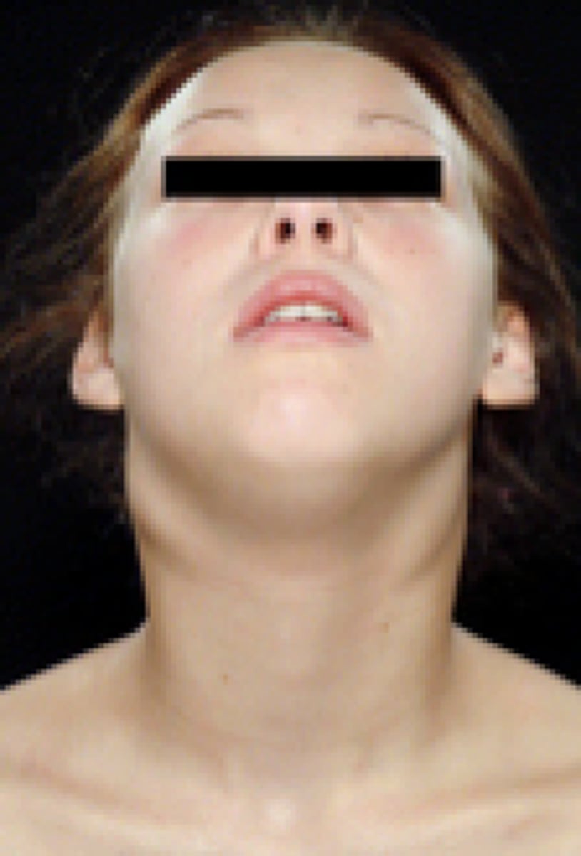 <p>Swelling of the lymph nodes, which can indicate infection</p>