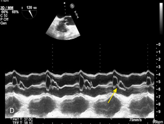 <p>What condition is seen in this 2D image?</p><p>What condition is it seen in?</p>