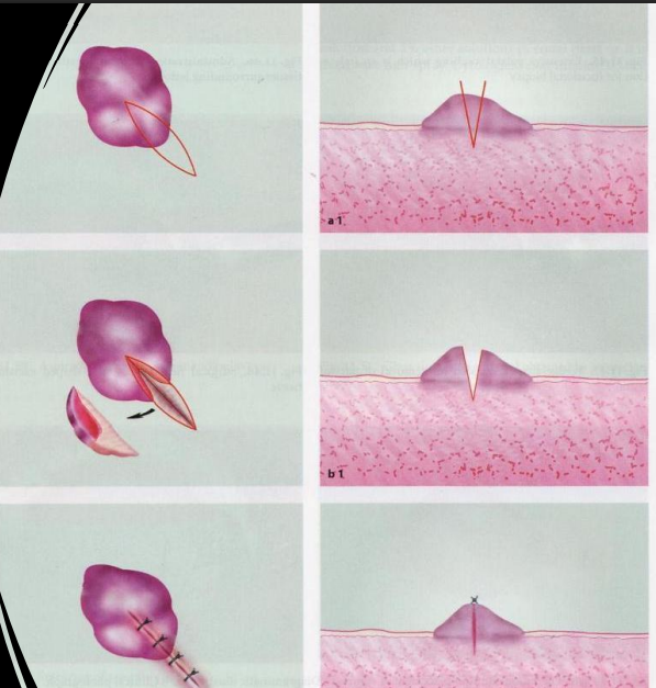 <p>lesions are larger than 2 cm</p>