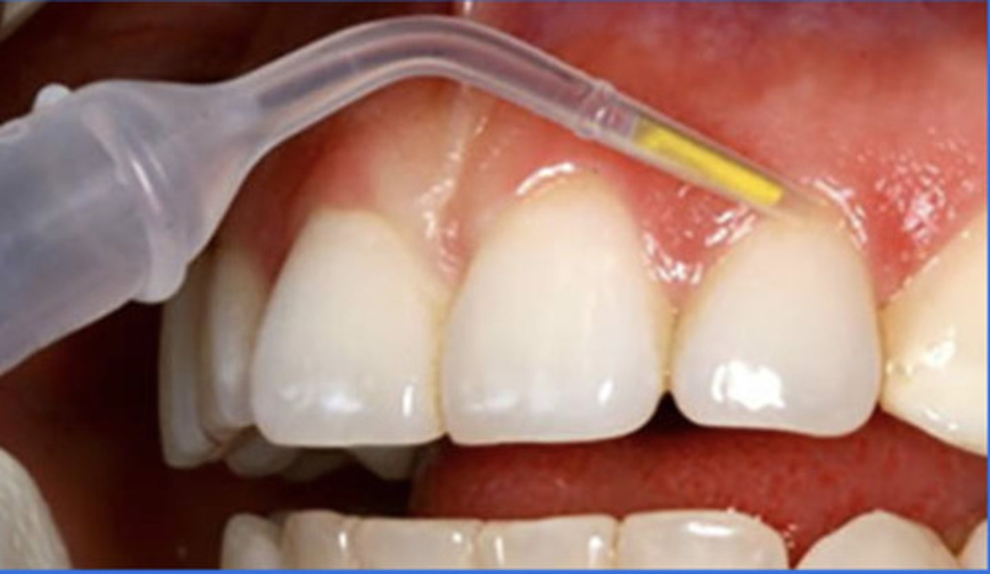 <p>4 of the statements below describe this image. which 4 are the correct statements that accurately describe the image?</p><p>1. doxycycline</p><p>2. minocycline</p><p>3. works within 1 hour</p><p>4. works immediately</p><p>5. don't brush teeth for 12 hours</p><p>6. lasts for 21 days</p><p>7. 1mg dispensed</p><p>8. 5mg dispensed</p>