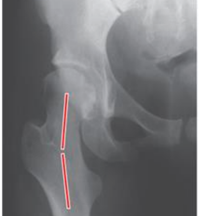 <p>-angle of inclination is > normal </p><p>-decreases abduction moment arm leading functionally weakened hip and increased joint reaction force </p><p>-decreased stability due to lessened coverage of the femoral articular surface with the acetabulum </p><p>-prediposes to hip dislocation </p>