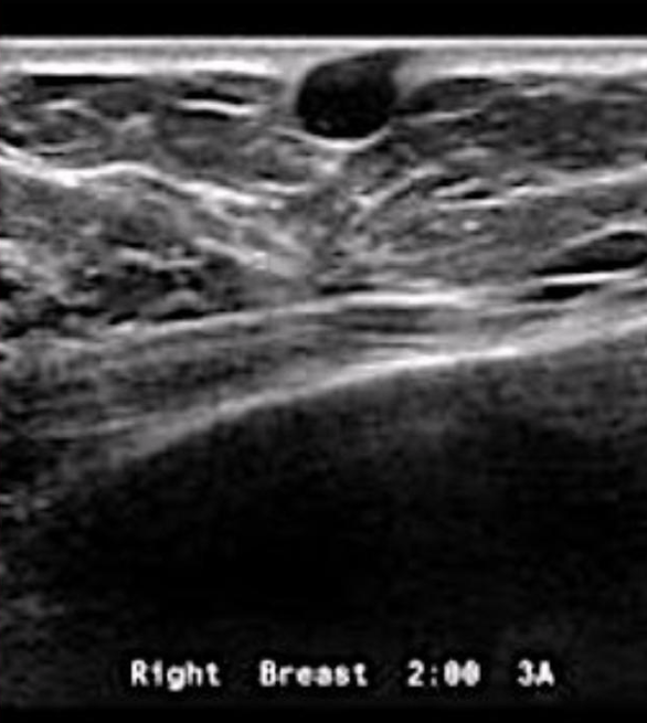 <p><span>cyst located within the dermal layer and has a tract connecting it to the skin</span></p>