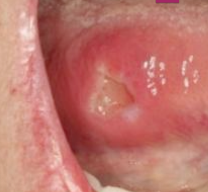 <p>What is Traumatic Ulcerative Granuloma with Stromal Eosinophilia (TUGSE)</p>