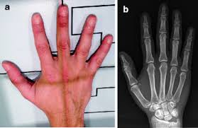 <p>3rd metacarpophalangeal (MP) Joint</p>