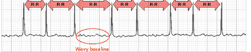 <p>no P waves, indicating no atrial activity at all, or fine undulations (rising and falling) resembling an old saw</p><p></p><p>irregularly irregular ventricular activity: random, no pattern </p>