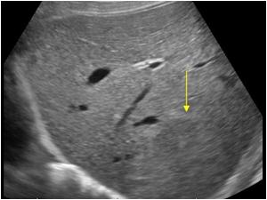 <p>27-year-old woman is seen for an ultrasound of the liver after a C-section. The OB reported a hard liver mass at the time of surgery. The ultrasound shows an isoechoic mass of the liver that is relatively homogeneous. The patient states that she was taking oral contraceptive for seven years before the pregnancy, what’s most likely the diagnosis</p>
