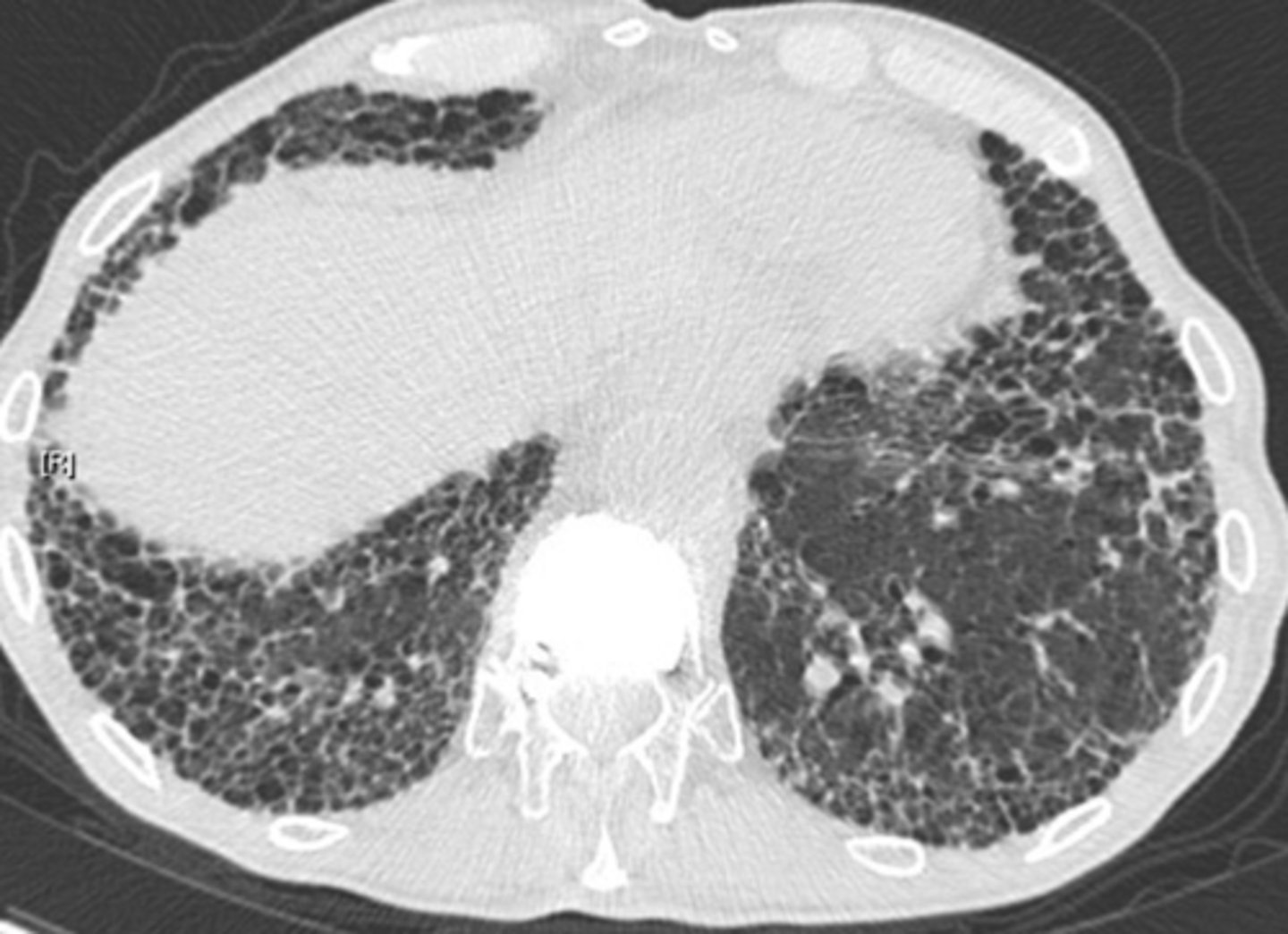 <p>bronchiectasis</p>