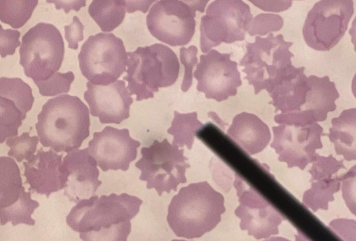 <p>A. Identify the pointed cell</p><p>B. Describe the striking feature</p><p>C. Is not associated with pathological condition (True or False)</p><p>D. What formation can be seen from this cell?</p>