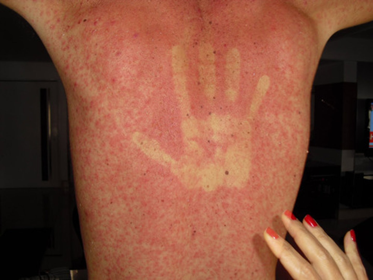 <p>dengue fever, hand print stays on rash</p>