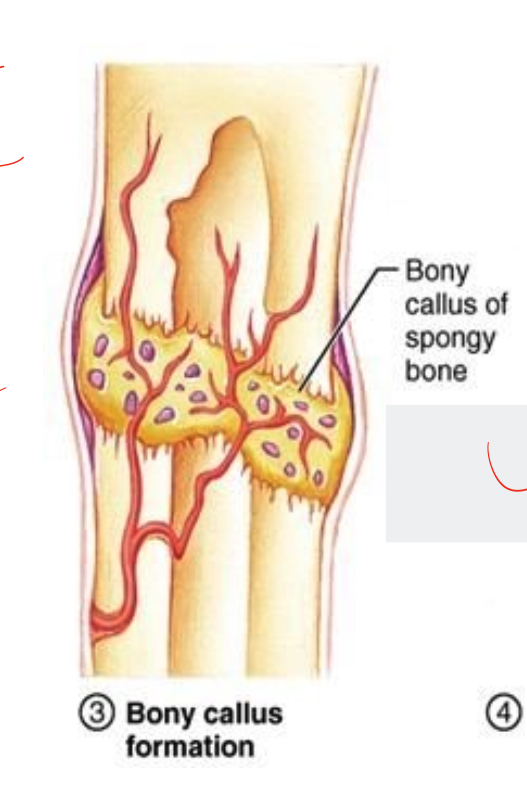 <ul><li><p>8-12 weeks </p></li><li><p>osteoblasts minerlize the soft callus and from a hard callus of woven bone, increases stability </p></li><li><p>still immature and weak, bridging of the fracture </p></li><li><p>clinical and radiological healing during this phase </p></li><li><p>phase is complete when fracture is stable </p></li></ul><p></p>