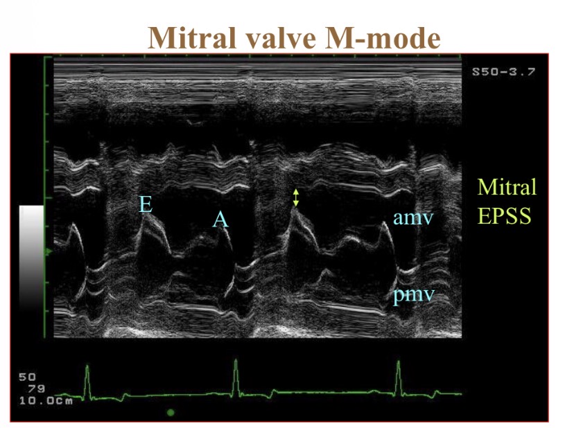 <p>How many times does M valve open in systole </p>