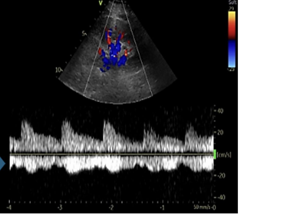 <p>which describes the normal doppler waveform in the proximal renal vein </p><p>.</p><p>a) respiratory phasicity + mild pulsatility</p><p>b) mild pulsatility w/no respiratory changes</p><p>c) respiratory phasicity w/no pulsatility </p><p>d) continuous flow </p>
