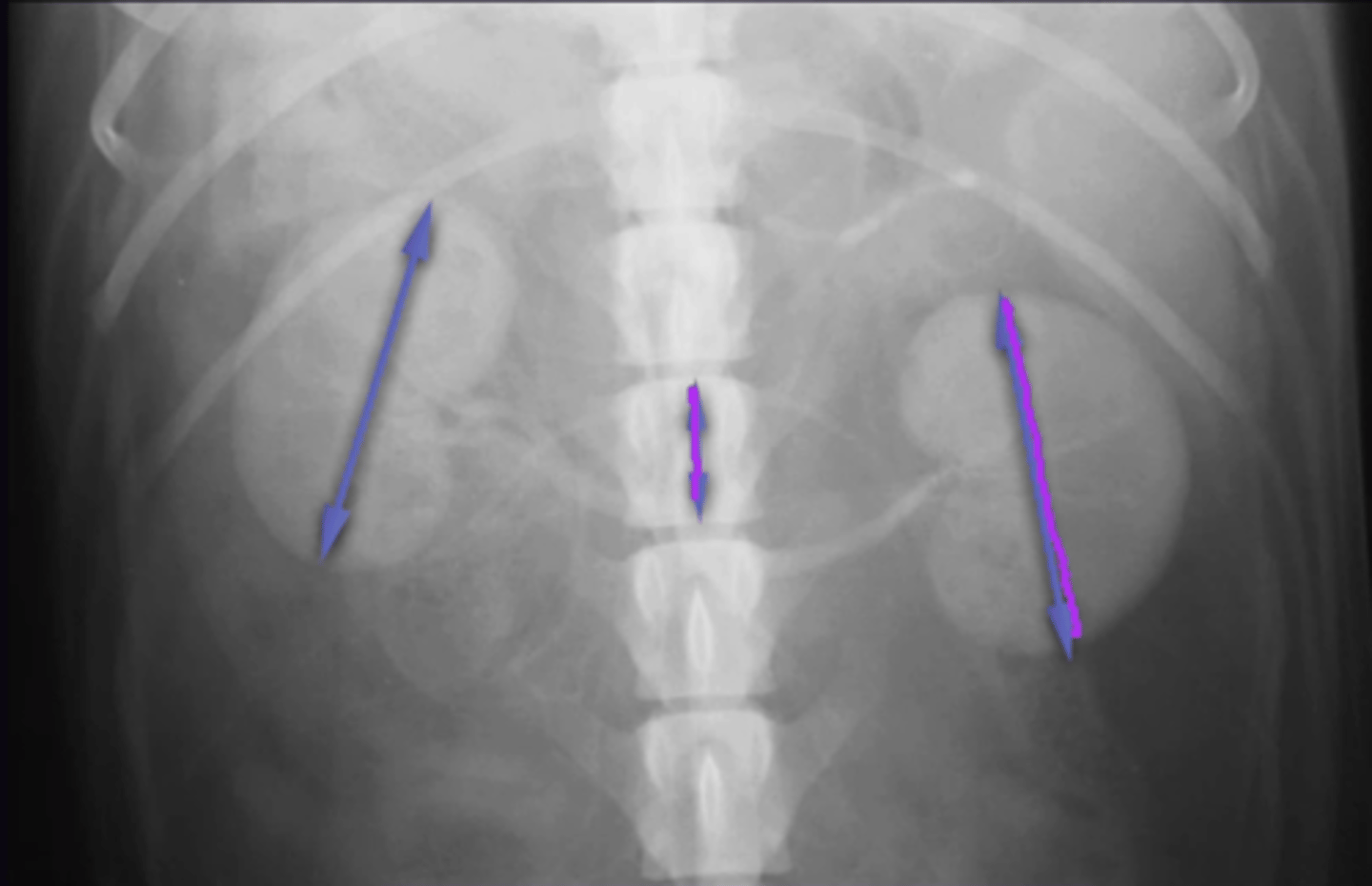 <p>1. Are they the same size, are they normal size compared to L2</p><p>2. Only VD</p><p>3. Length Kidney : Length L2</p><p>4. 2.5-3.5</p><p>5. 1.9-2.6</p>