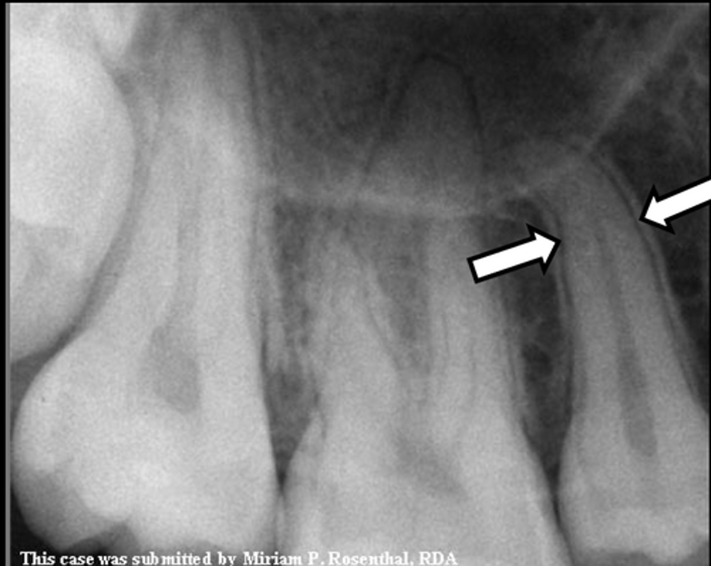 <p>A thin radiolucent line around the root of a tooth</p>