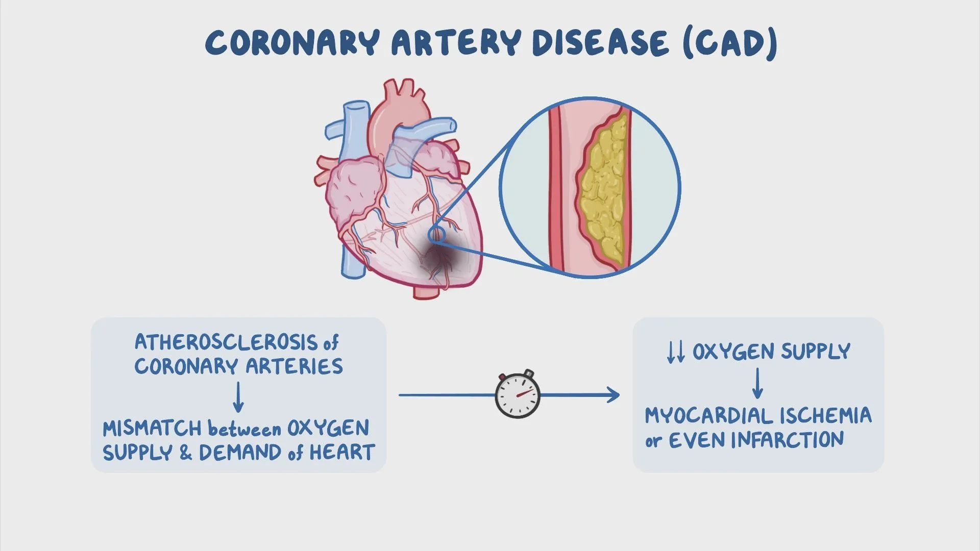 <ul><li><p>Also called <strong>Coronary Artery Disease (CAD)</strong></p></li><li><p><strong>reduced blood flow to the heart muscle</strong> (myocardium) occurs due to <strong>narrowing or blockage</strong> of coronary arteries</p></li><li><p>usually from <strong>atherosclerosis</strong></p></li><li><p><strong>Pathophysiology:</strong></p><ul><li><p>Atherosclerosis → Plaque buildup in coronary arteries</p></li><li><p>↓ Blood supply to myocardium → <strong>Myocardial ischaemia</strong></p></li><li><p>Can be <strong>stable</strong> or <strong>acute</strong></p></li></ul><p><strong>Clinical Presentations:</strong></p><ul><li><p><strong>Stable Angina</strong>: Chest pain on exertion, relieved by rest</p></li><li><p><strong>Unstable Angina</strong>: Chest pain at rest or minimal exertion</p></li><li><p><strong>Myocardial Infarction (MI)</strong>: Prolonged ischaemia → Heart muscle damage</p></li><li><p><strong>Silent ischaemia</strong> (especially in diabetics)</p></li></ul></li></ul><p></p>