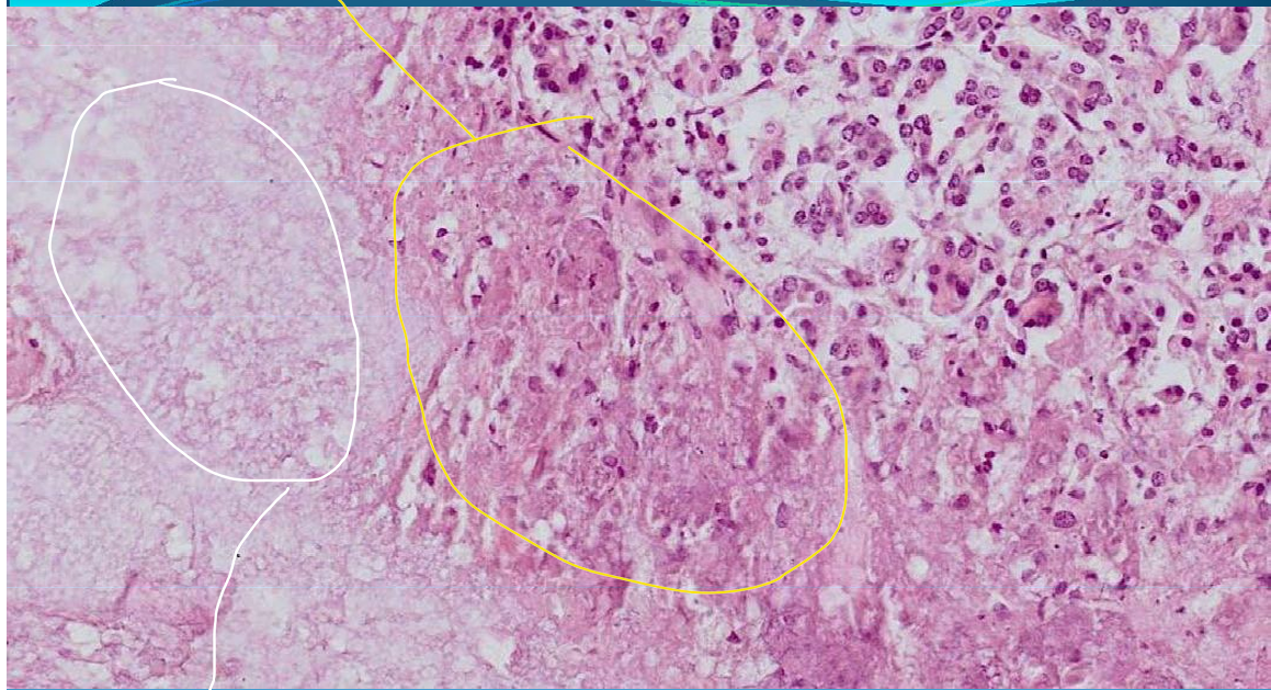 <p>PANCREAS:</p><p>Cytosteatonecrosis: acute hemorrhagic pancreatitis, ulcero-necrotic pancreatitis; necrosis of pancreatic tissue, fatty tissue and acini</p>