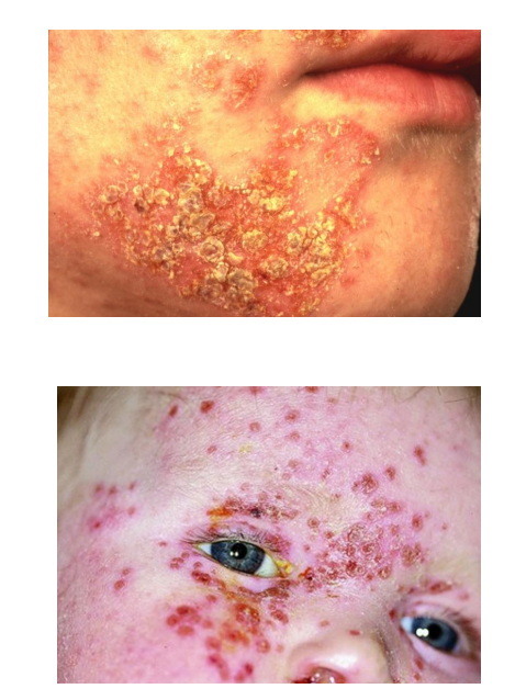 <ol><li><p><strong>Staphylococcus aureus (impetiginised </strong>eczema) <em>yellow crust and weeping (not impetigo)</em></p></li><li><p><strong>Herpes simplex</strong> (eczema herpeticum) <em>Monomorphic lesions - eye can be permanently affected - ophthalmologist needs to be involved </em></p></li></ol><p></p>
