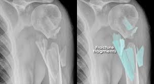 bone breaks into many fragments
