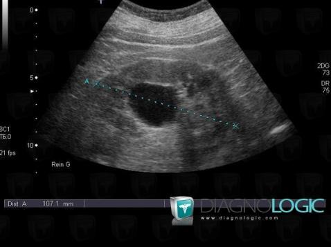 <p>Parapelvic cyst</p>